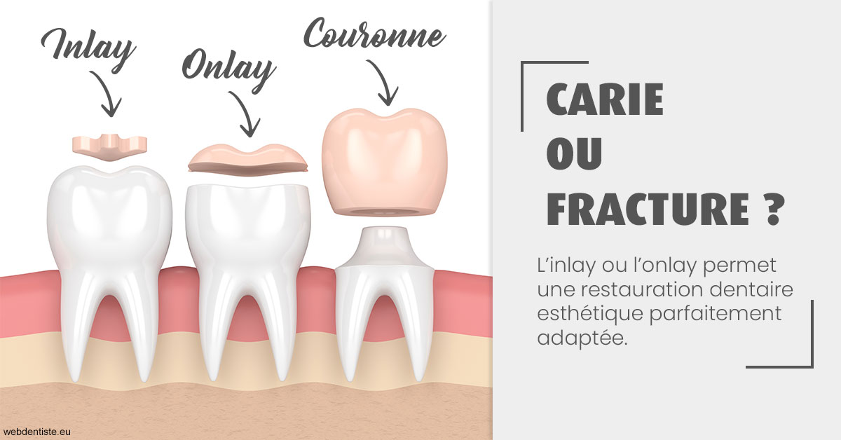 https://dr-crepin-julien.chirurgiens-dentistes.fr/T2 2023 - Carie ou fracture 1