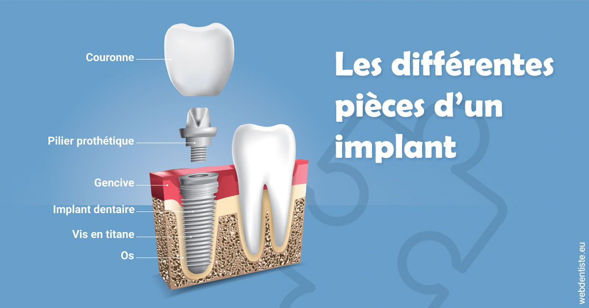 https://dr-crepin-julien.chirurgiens-dentistes.fr/Les différentes pièces d’un implant 1