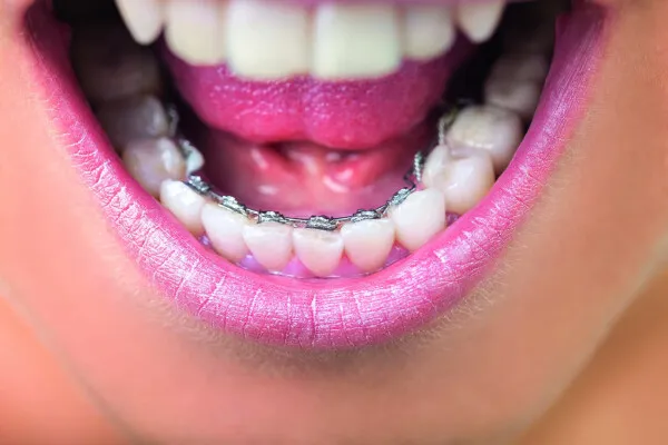 Orthodontie invisible